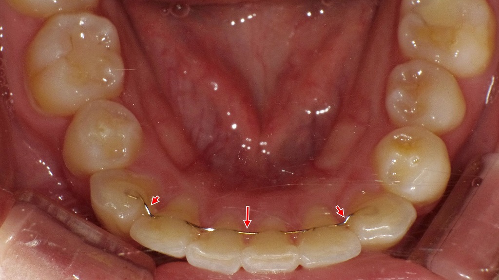 犬歯から犬歯までの固定式リテーナー