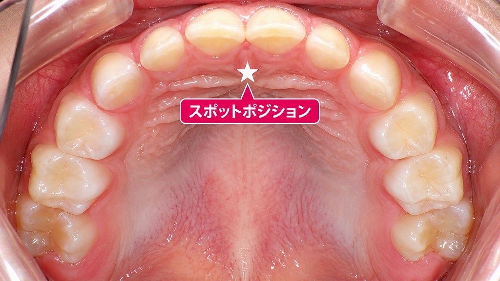 スポットポジション