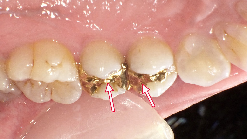 上顎小臼歯に装着された金合金インレー(自費)