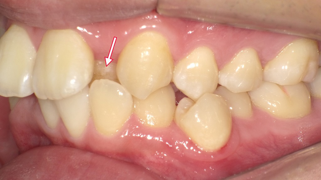 左上２番が歯槽性の反対咬合