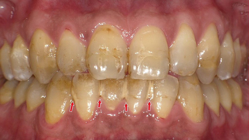 ドブ臭い口臭の原因：歯垢は除去できても“歯石”が大量に残存