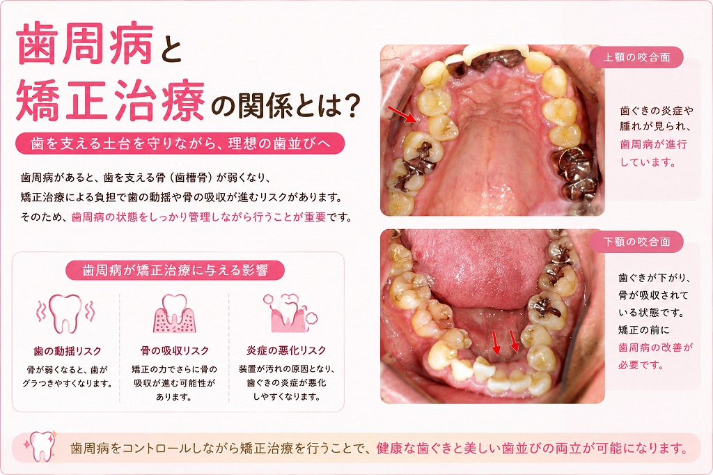 歯周病と矯正治療の関係とは？