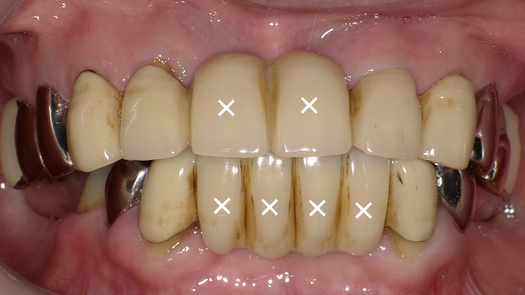 保険の硬質レジン前装冠ブリッジの見た目と審美性の限界(欠損部×印)