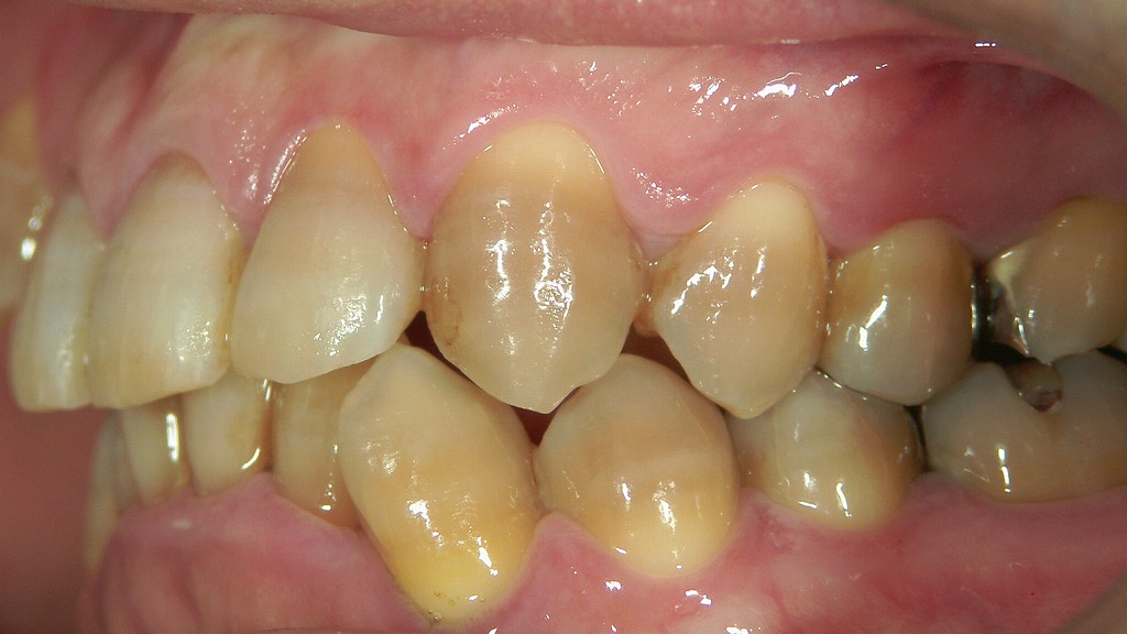 テトラサイクリン歯(抗生物質による歯の変色)