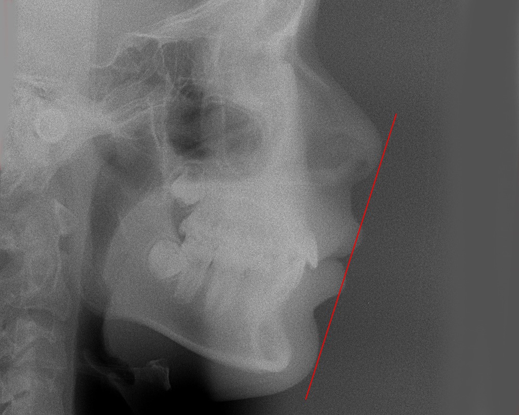 中学生／矯正終了後・Eライン改善・第一小臼歯抜歯症例