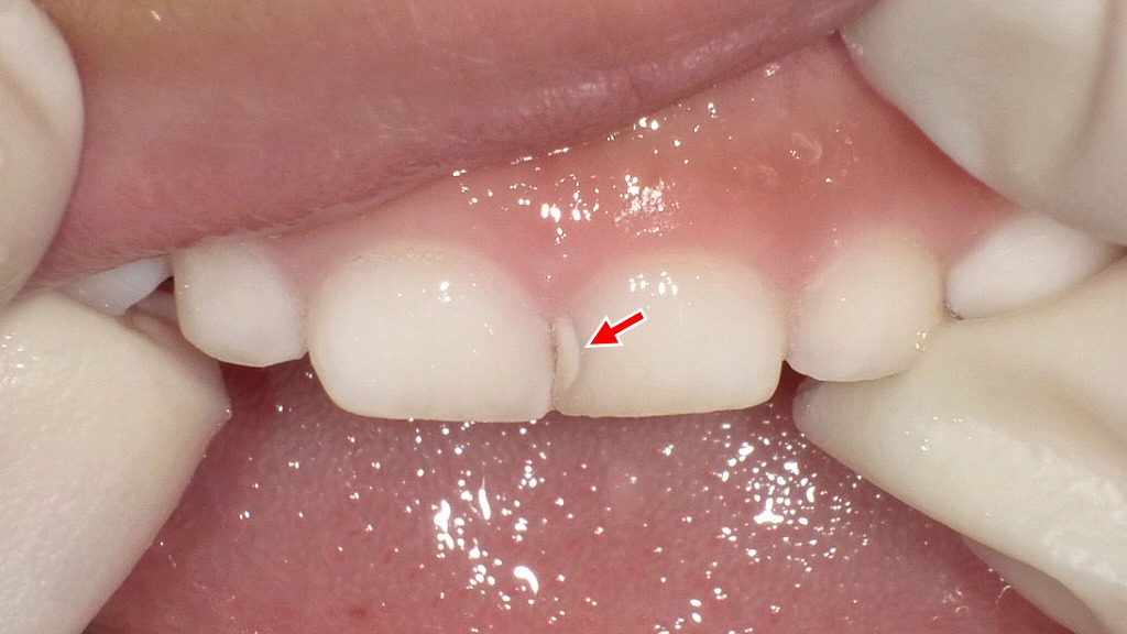 乳歯の虫歯は小さく見えても要注意