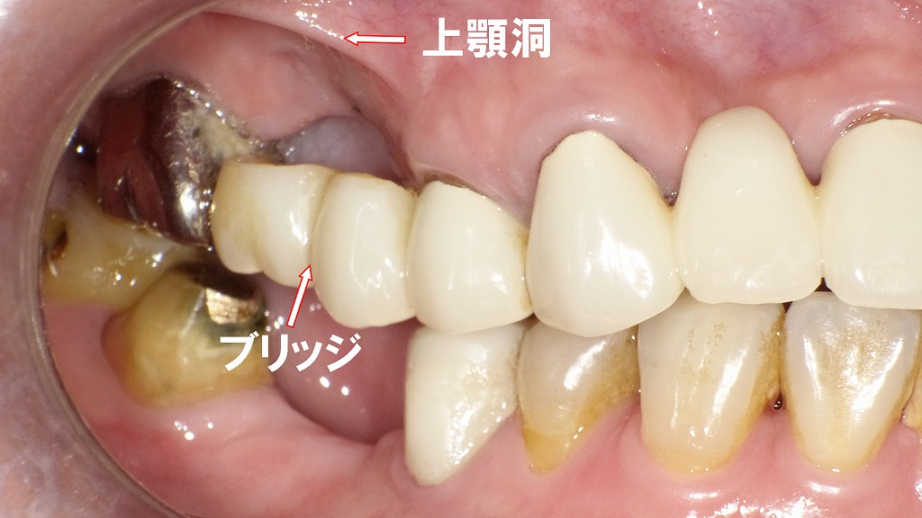 ブリッジ（4番〜7番）