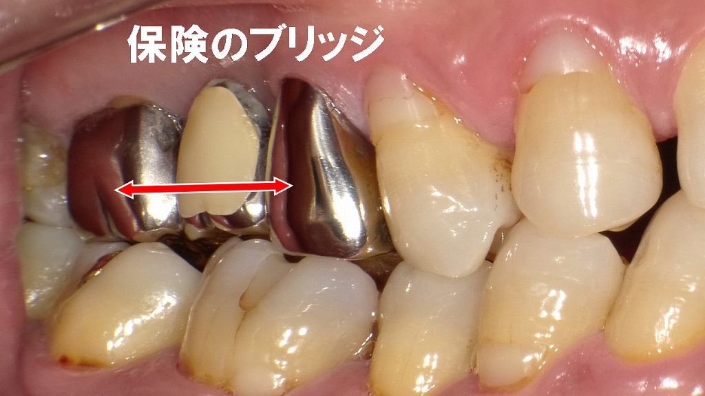 保険の奥歯ブリッジ:見た目・審美性のポイント