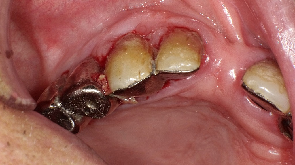 オーラルフレイルが疑われる口腔内所見。歯の喪失に加え、食物残渣と厚いプラーク付着が認められ、清掃不良による口腔機能低下が明確に示されています。