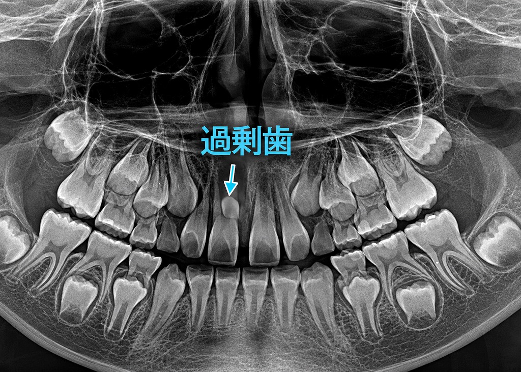 過剰歯