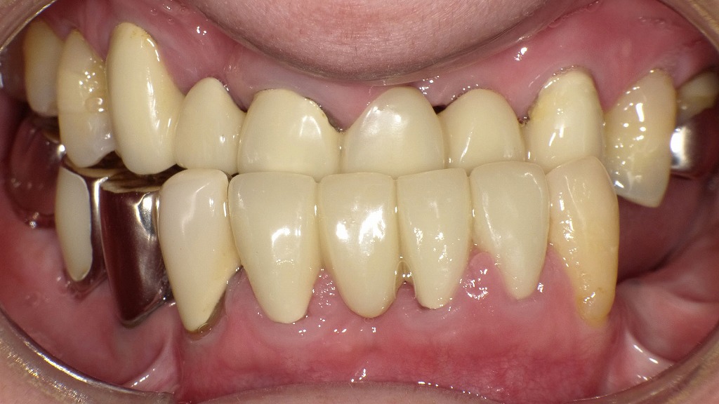 大人の受け口（反対咬合）