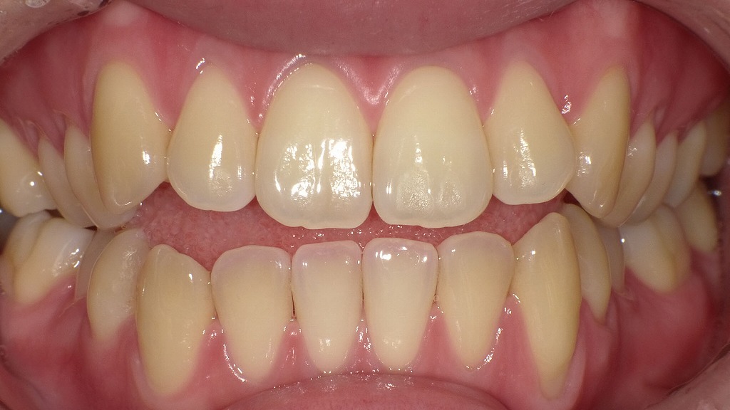 全体的に黄みが強く、歯の色調にばらつきが見られる状態でした。加齢や生活習慣による着色が影響しています。