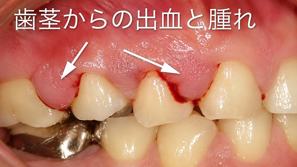 薬剤性歯肉増殖症による歯茎の腫れ