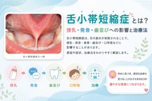 舌小帯短縮症とは？授乳・発音・歯並びへの影響と治療法