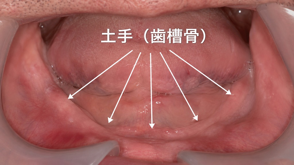 下顎の歯槽提（歯茎の土手）