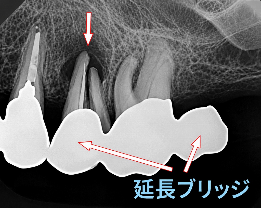上顎第2小臼歯が歯根破折