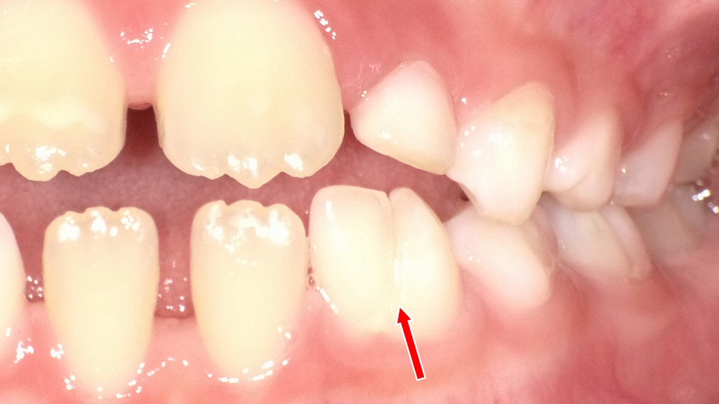子どもの癒合歯の症例