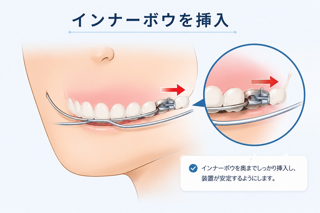 インナーボウをスロットに挿入