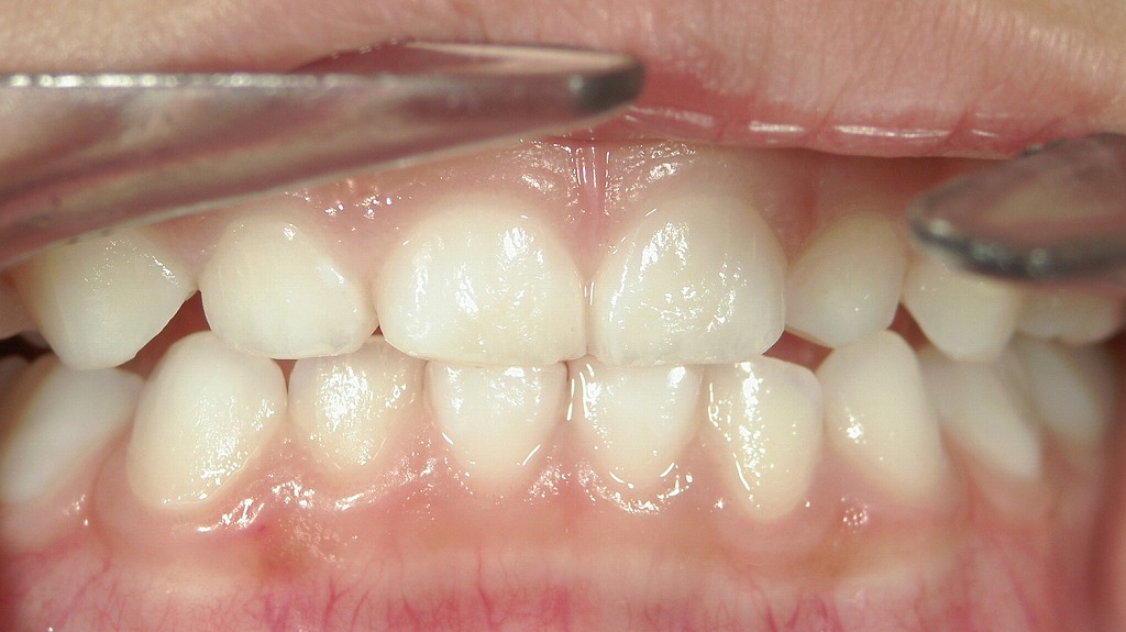 乳歯の間にすき間がほとんどない“密な歯列”