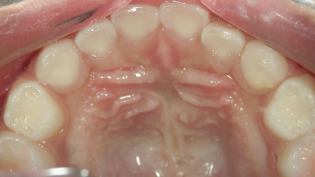 上の歯がぎっしり並び、アーチに余裕がない状態