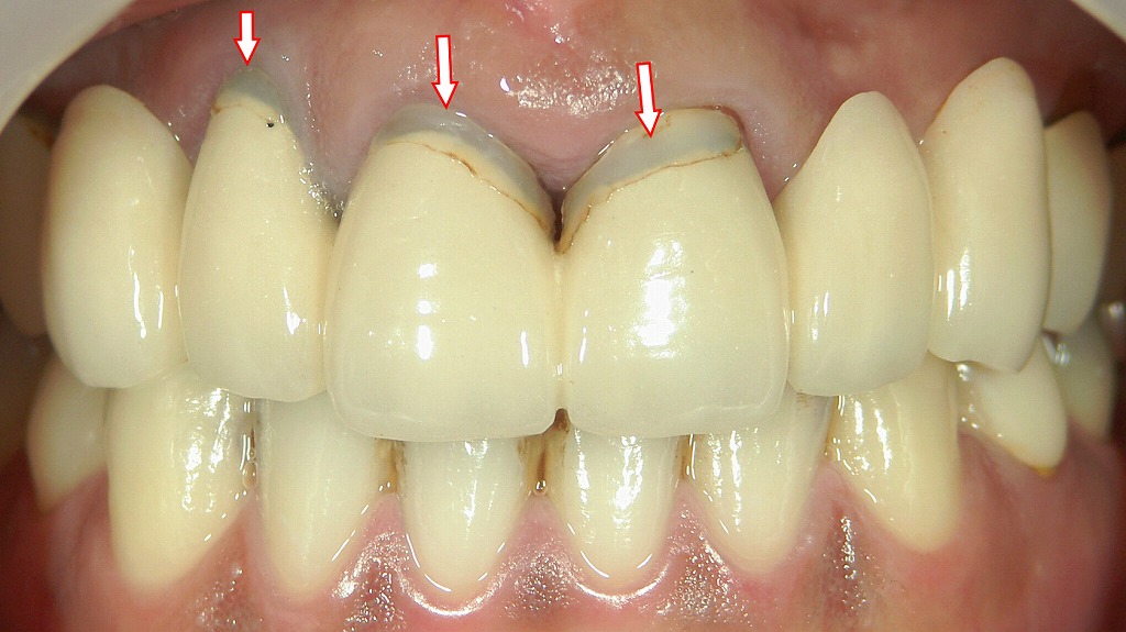 歯肉退縮による審美的問題