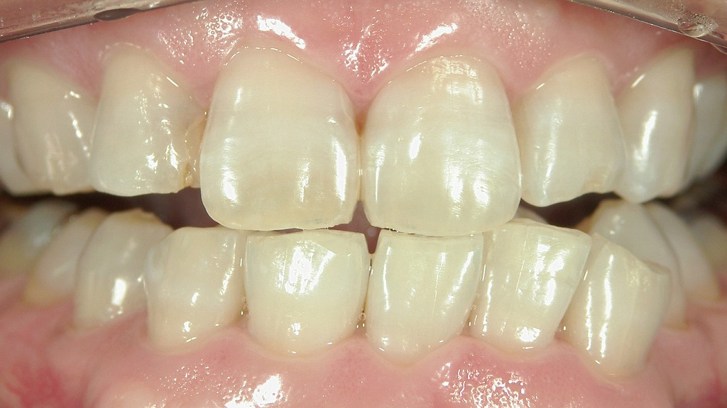 2枚目：ホワイトニング後（ペリクル除去・脱水で無防備な状態）