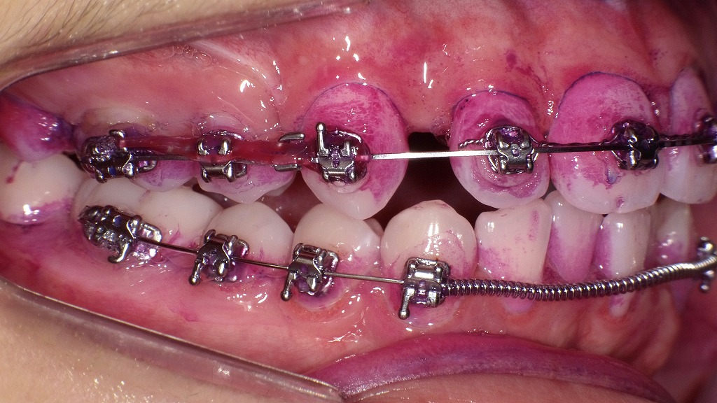 矯正中の磨き残しが一目でわかる！プラーク染め出しによるリスク評価