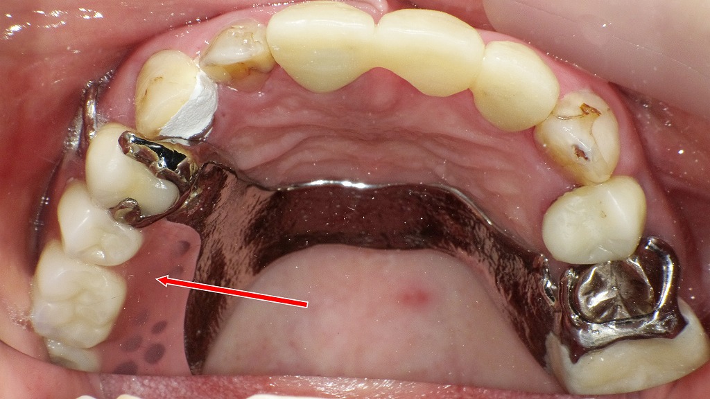 上顎の金属床義歯（金属床部分入れ歯）