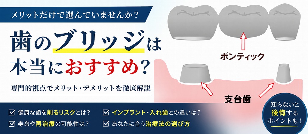歯のブリッジは本当におすすめ？