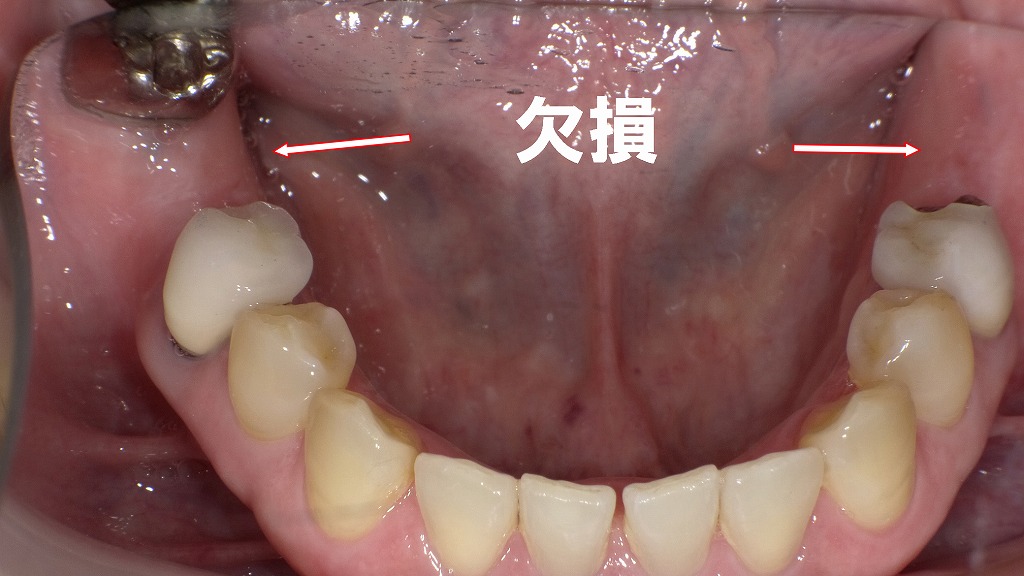 術前：欠損状態
