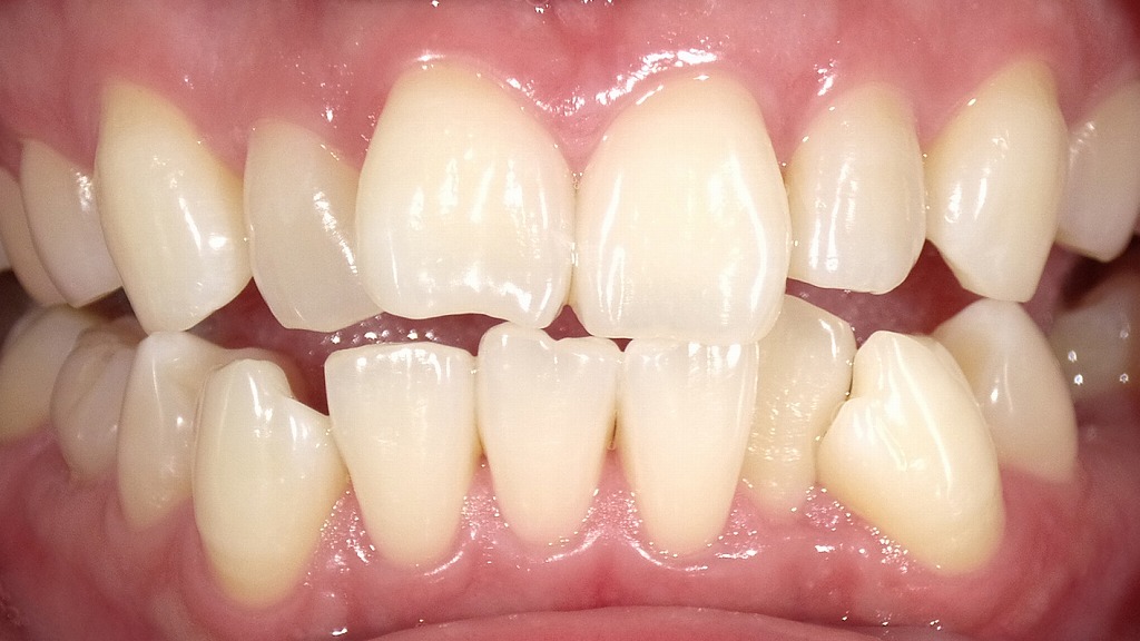 2枚目：ホワイトニング後