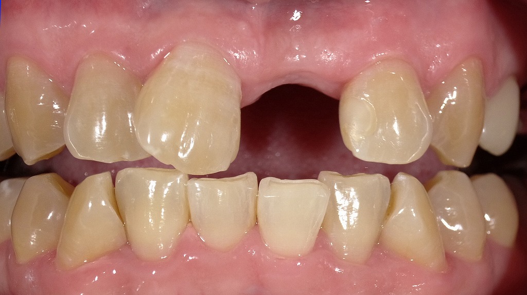 2枚目:ホワイトニング後(左上1番は部分矯正後・インプラント予定の状態)