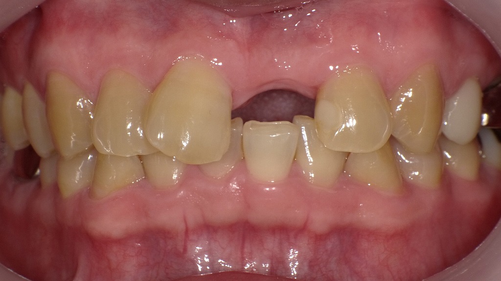 1枚目:ホワイトニング前