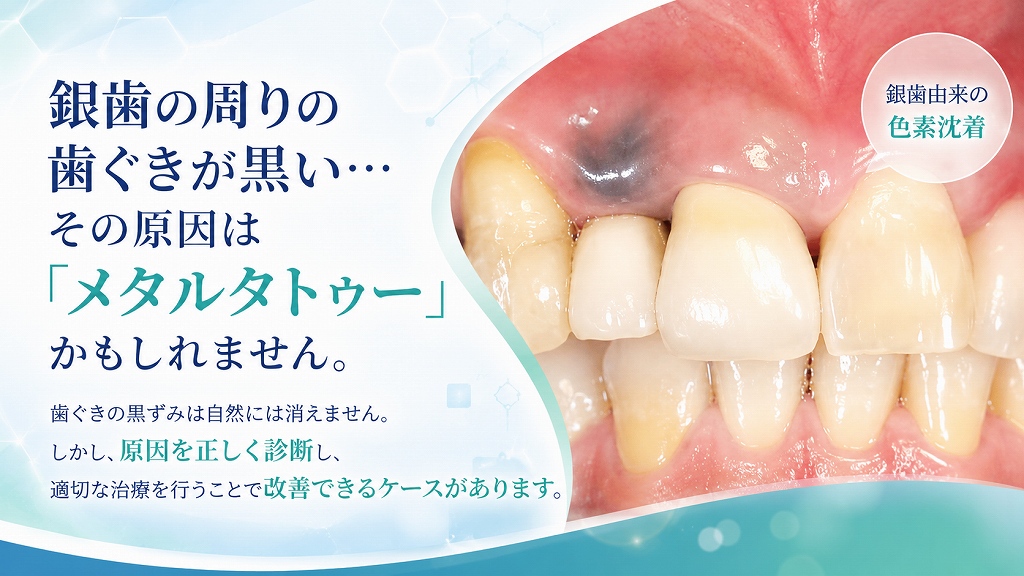 保険診療の差し歯のメタルタトゥー
