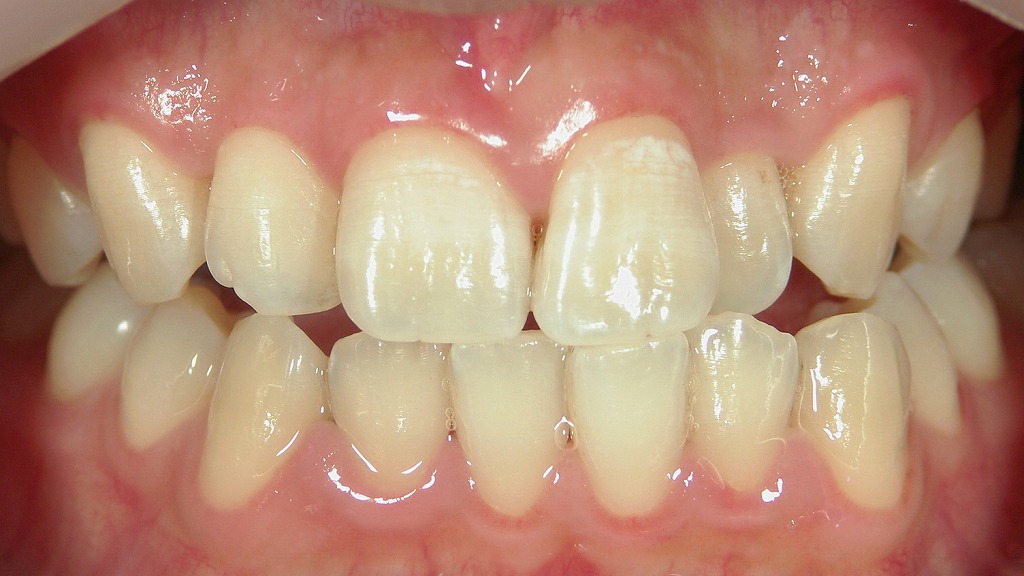 1枚目:ホワイトニング前の歯