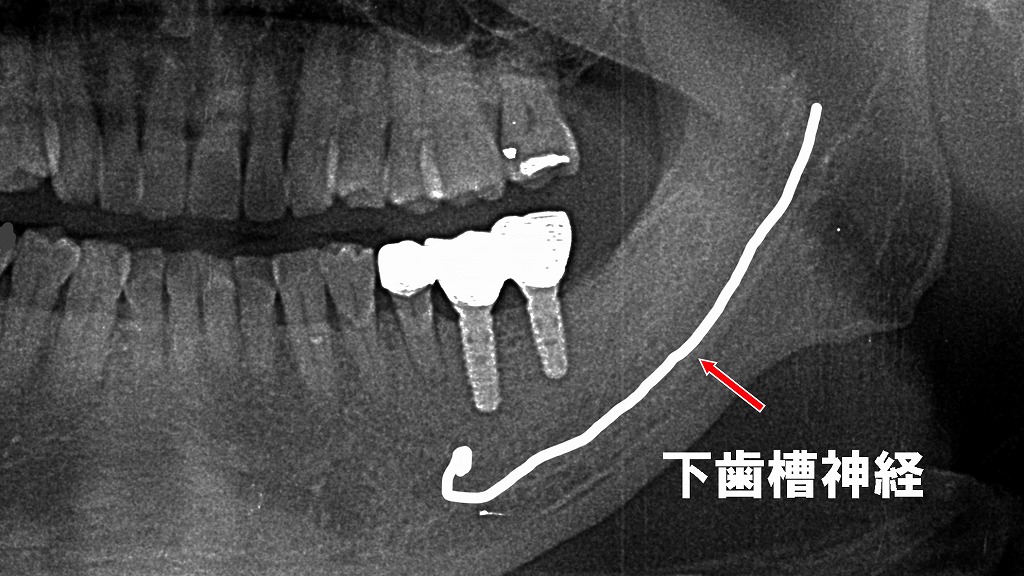 術後：上部構造装着後のパントモレントゲン所見