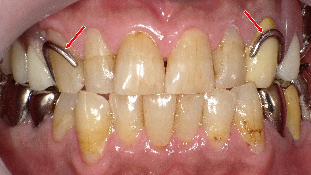 保険適用の部分入れ歯