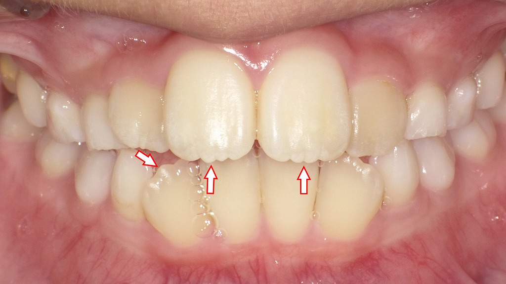 7歳児のマメロン（永久歯の生えたて形状）