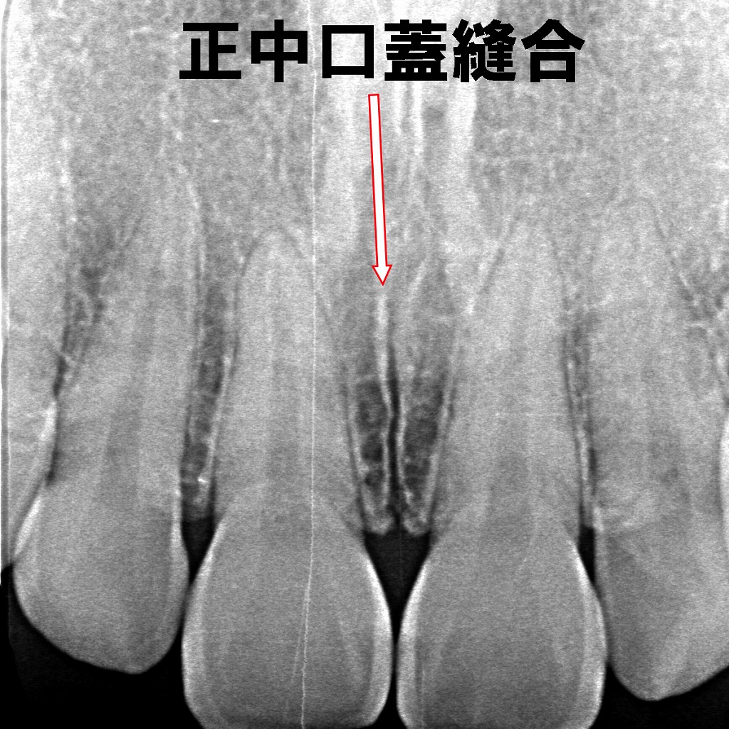 正中口蓋縫合:矢印部分に垂直方向の細い透過線(黒い線)が見られる