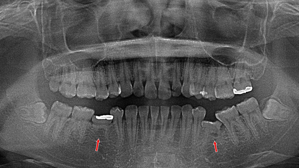 永久歯が生えてこない? 下顎の乳歯が残る先天欠損のケース