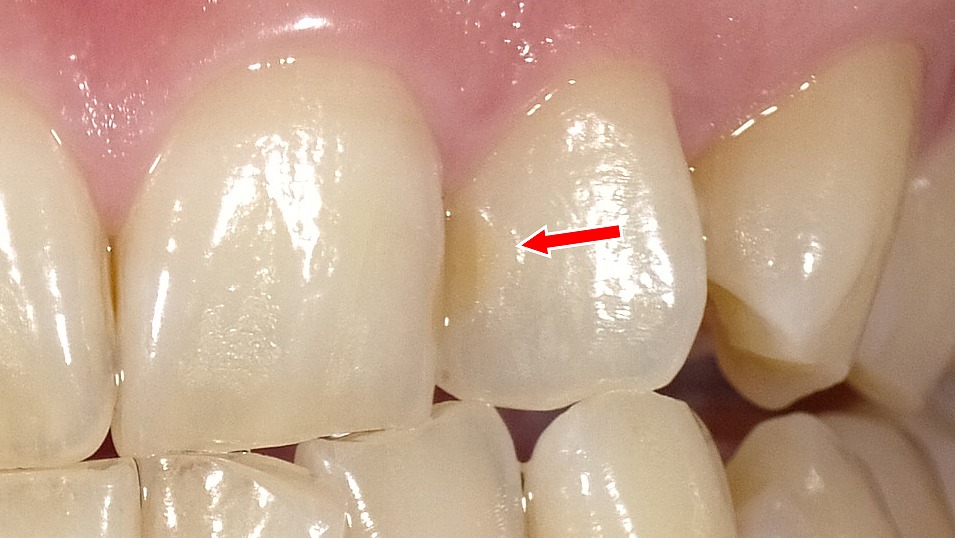 コンポジットレジン充填