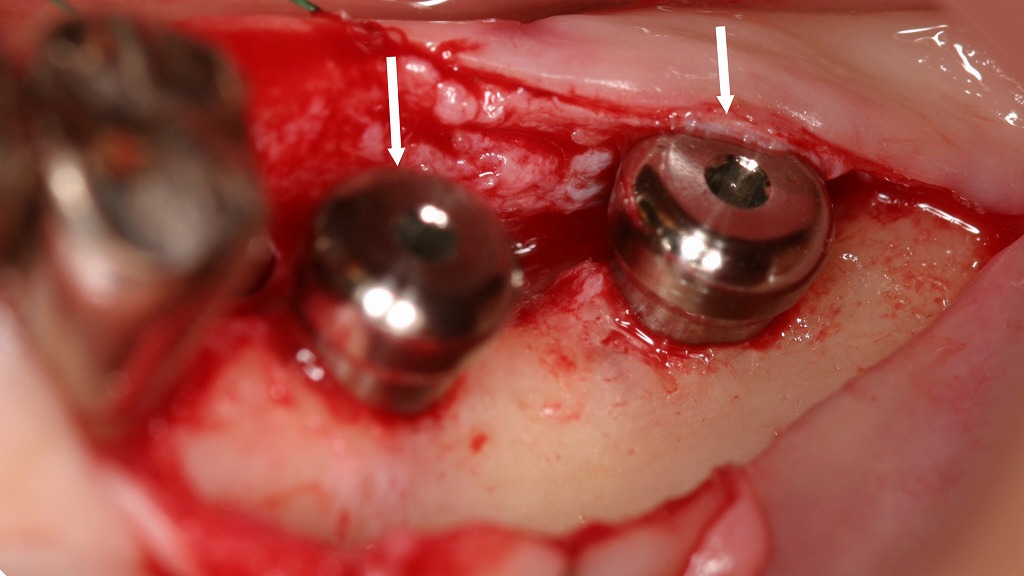 インプラント埋入が完了