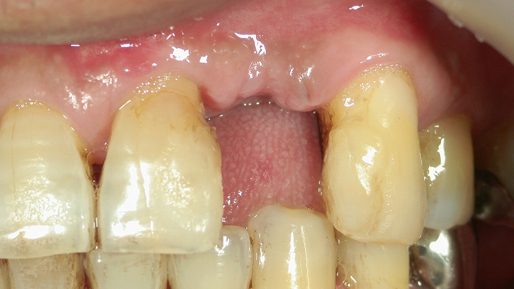 左上2番の欠損による審美・咬合への影響