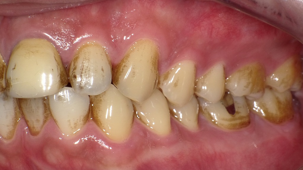 着色しやすい食習慣の影響｜定期クリーニングで清潔な口元を維持