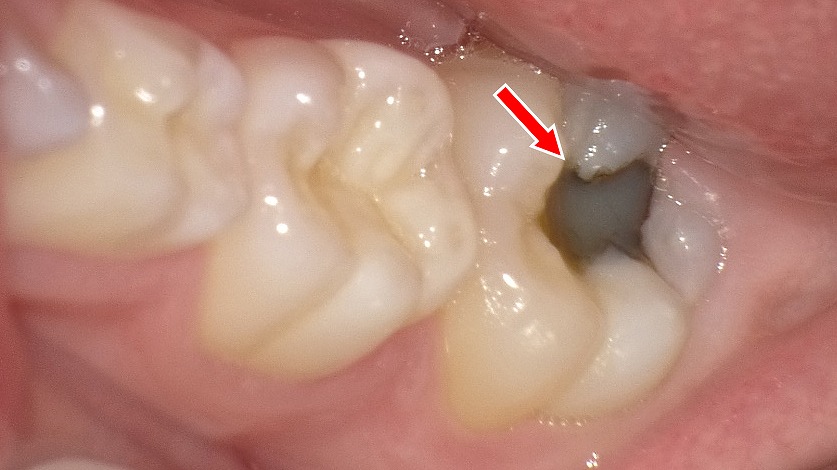 6歳臼歯の虫歯｜生えたばかりの奥歯に要注意