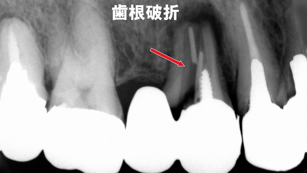 4番に負担集中：歯根破折
