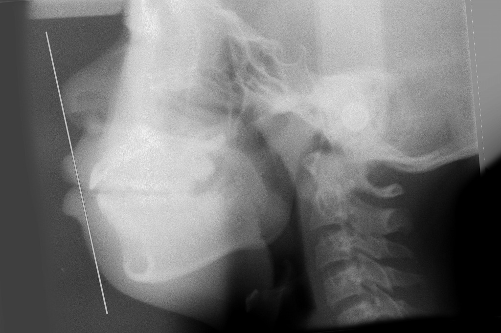 子どものオープンバイト（開咬）症例の側方セファロ