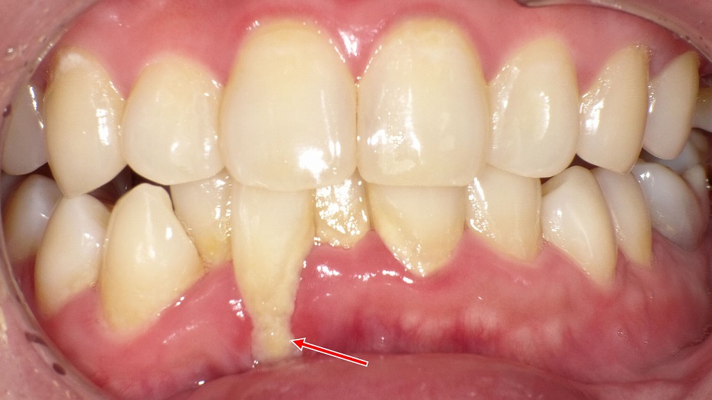 歯周病による歯肉裂開と歯石・歯垢の蓄積