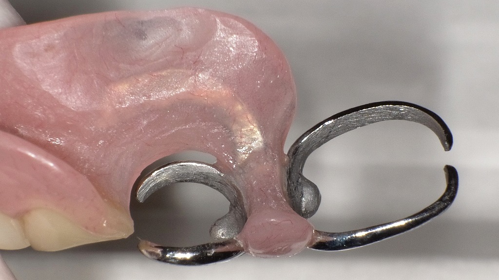 鋳造クラスプ：裏面