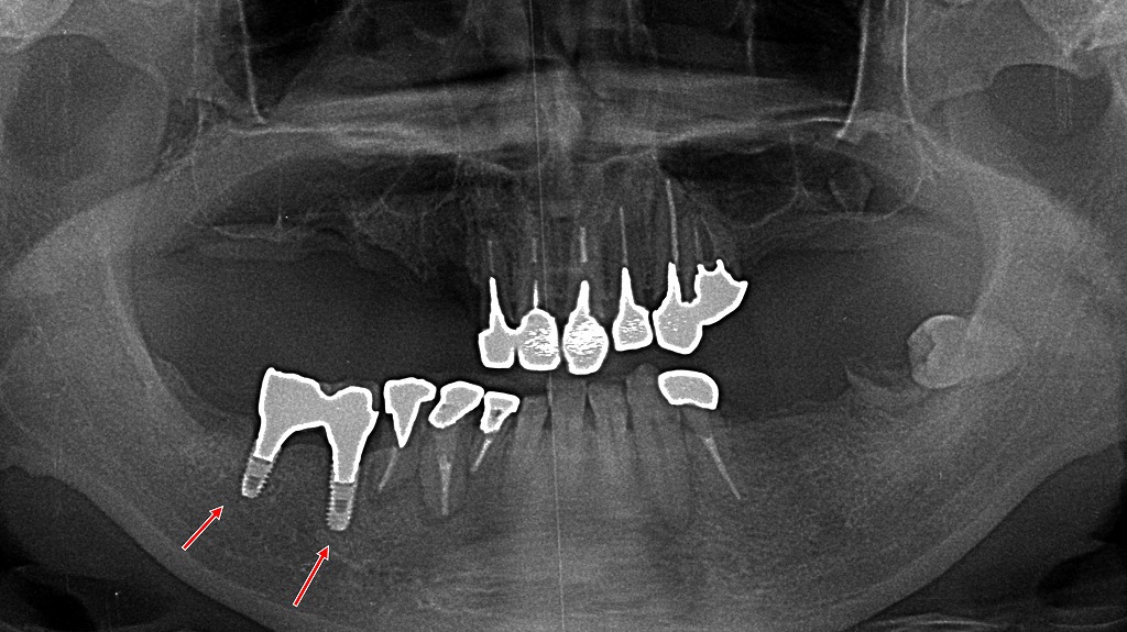 下顎5・6番相当部にインプラント